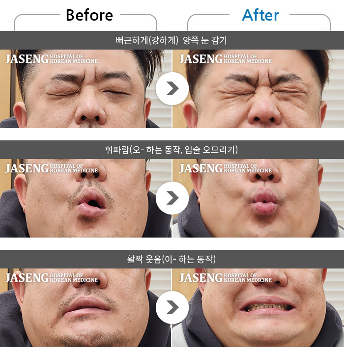 �ڻ��ѹ溴�� ġ���� �ȸ�Ű渶�� ġ����-���� ���� �� �ȿ����̰� ���� ������ ������ ����.