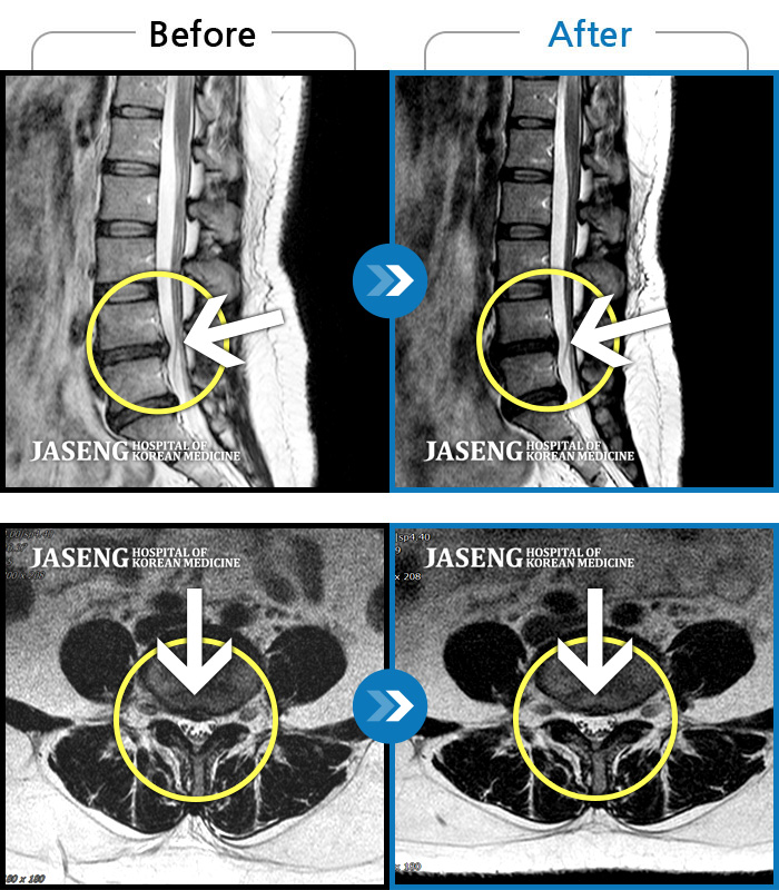 ڻѹ溴 ġ MRI  ġ- ħ ġḦ Ͽ ȣ Ǿٰ       ϰ ߻Ͽ   ũ ġḦ  ȯ Դϴ. 