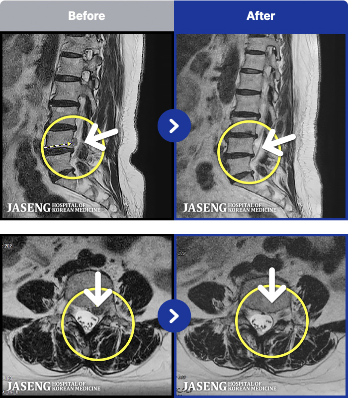 �λ��ڻ��ѹ溴�� ġ���� MRI�� ���� ġ����-�㸮�� �ʹ� ������ �ٸ��� ������