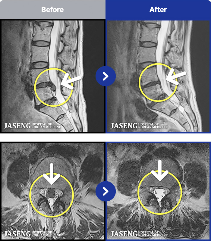 �λ��ڻ��ѹ溴�� ġ���� MRI�� ���� ġ����-�㸮�� ���� �ٸ��� ���� ����