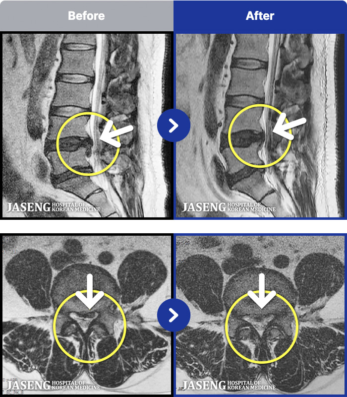 �λ��ڻ��ѹ溴�� ġ���� MRI�� ���� ġ����-������ ���ϰ� ���� �ٸ� ������ ���� ���� �׸��� ���� �߰��� �ٷ� ���Ϸ� �ϻ��Ȱ�� ����� ���¿����ϴ�.