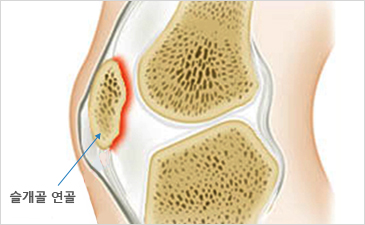 부산자생한방병원 무릎질환 슬개골연골연화증-슬개골 연골이 위치해 있는 무릎 설명 이미지