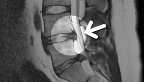MRI  3