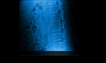 부산자생한방병원 허리질환 척추후만증-척추후만증에 관련된 이미지 입니다.